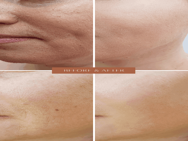 ORGANIC HYALURONIC WRINKLE DEFIER - For Women and Men