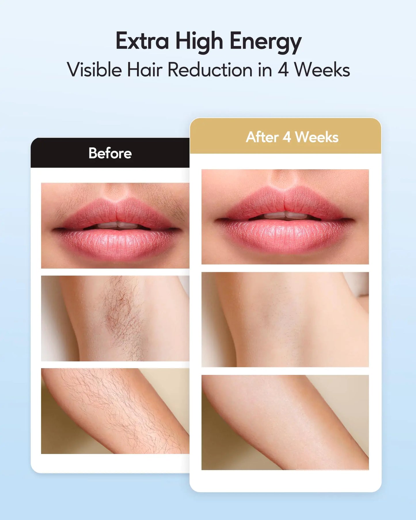 INNZA Laser Hair Removal with Ice Cooling